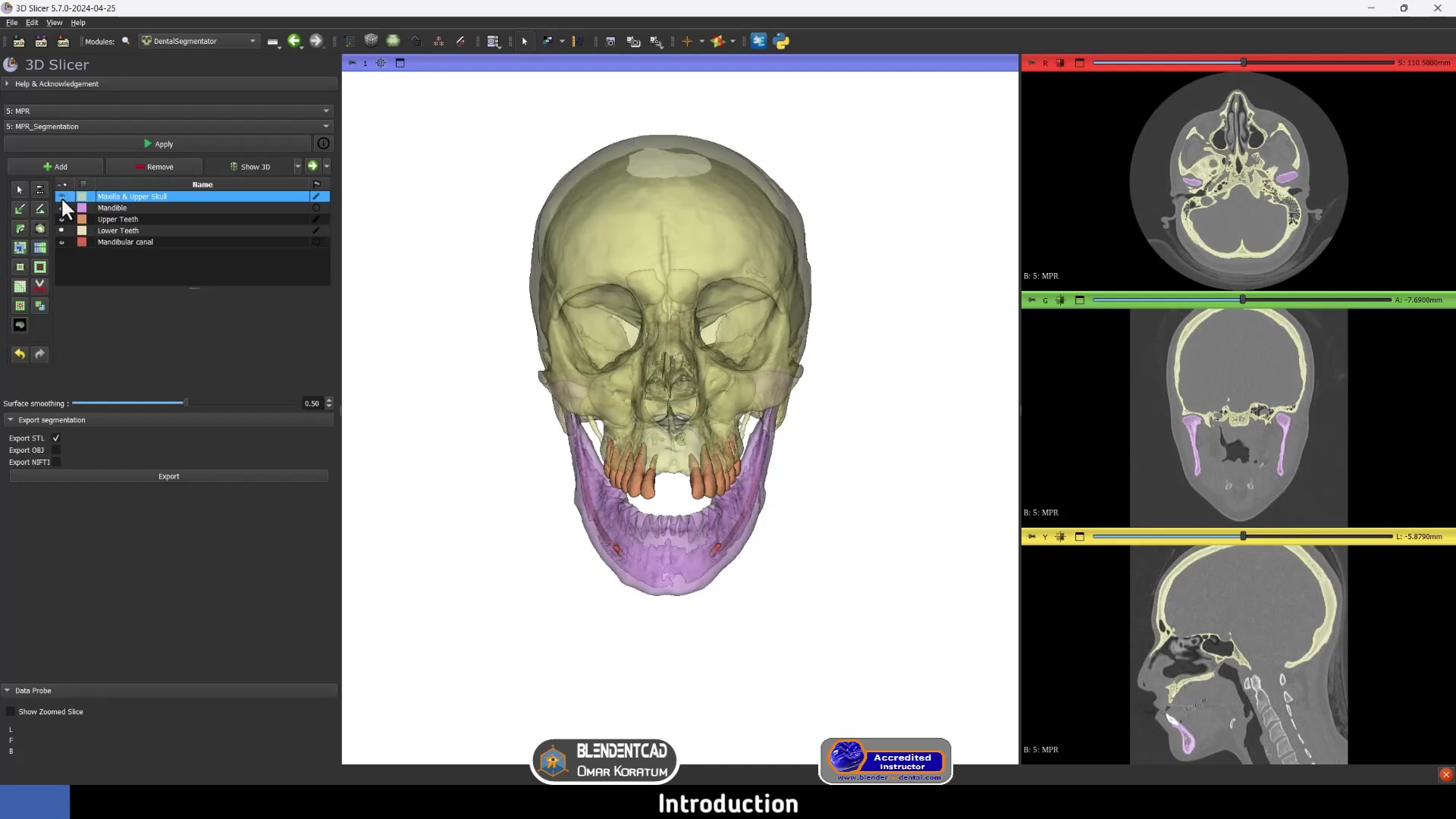 3D Slicer STL Export: Print Dental Models | DentIIT