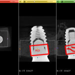 3D Slicer Templates: Plan Implants Faster | DentIIT