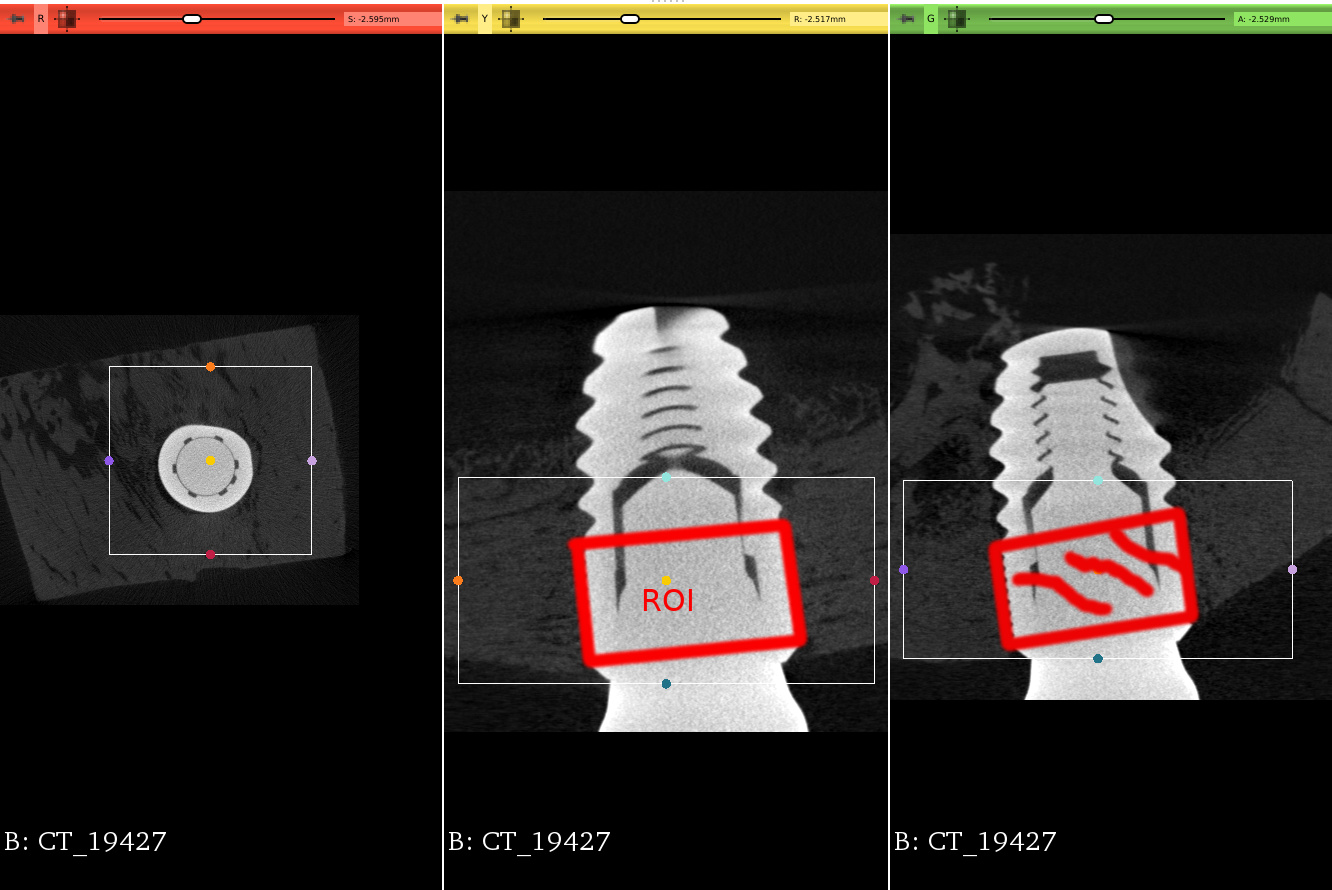 3D Slicer Templates: Plan Implants Faster | DentIIT