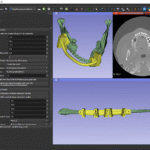 3D Slicer Prosthodontics: Design Digitally | DentIIT