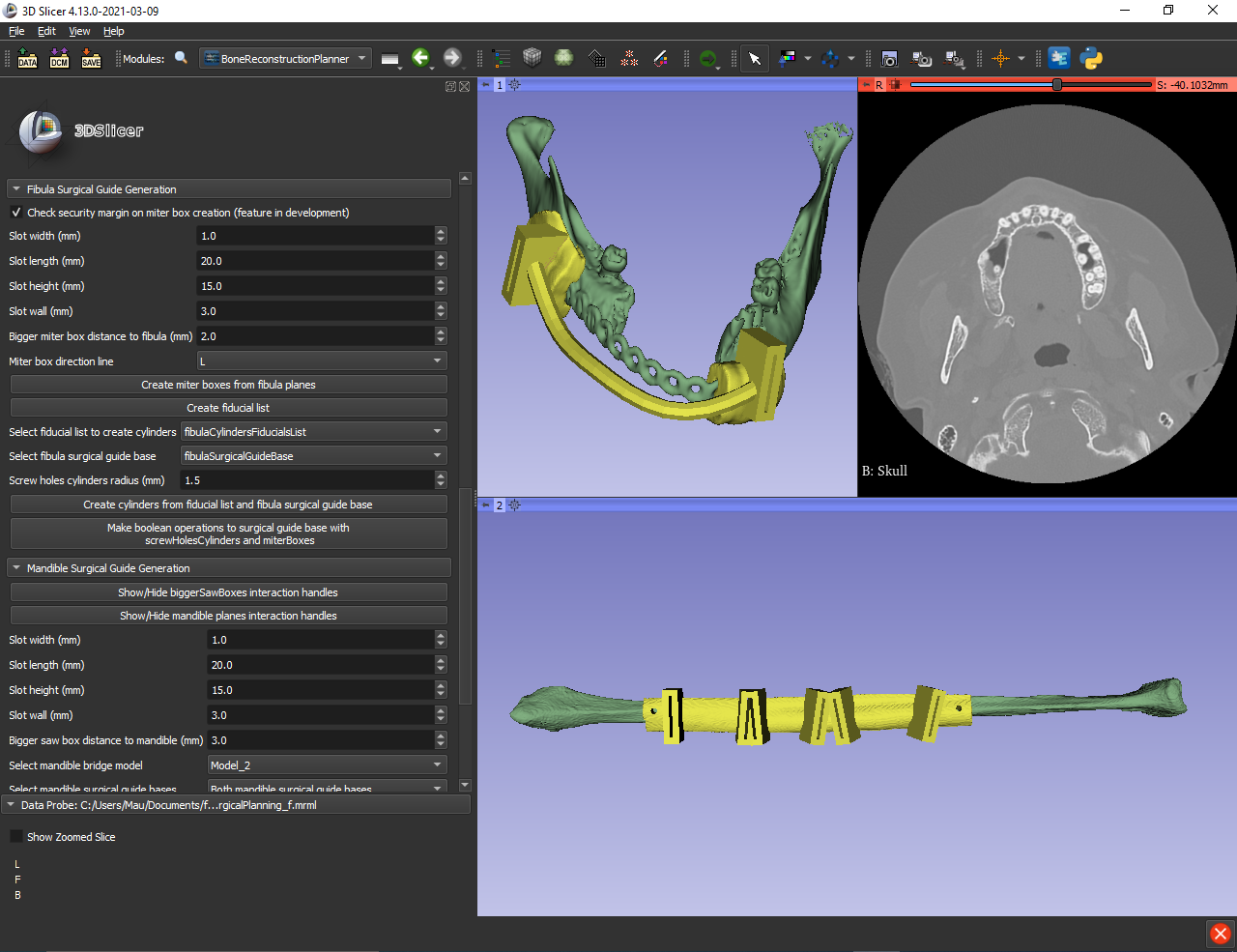 3D Slicer Prosthodontics: Design Digitally | DentIIT