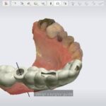 3D Slicer Printing: From Scan to Model | DentIIT
