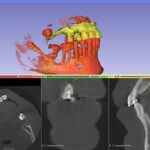 3D Slicer Surgery: Virtual Planning Made Easy | DentIIT