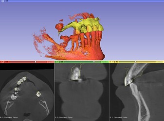 3D Slicer Surgery: Virtual Planning Made Easy | DentIIT