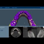 3D Slicer Orthodontics: Align Digitally | DentIIT
