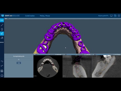 3D Slicer Orthodontics: Align Digitally | DentIIT
