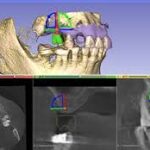 3D Slicer Implantology: Plan Smarter | DentIIT