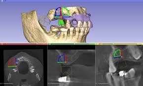 3D Slicer Implantology: Plan Smarter | DentIIT