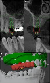 3D Slicer Pricing: Free Yet Powerful | DentIIT