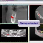 3D Slicer CAD/CAM Integration: Smart Workflow | DentIIT