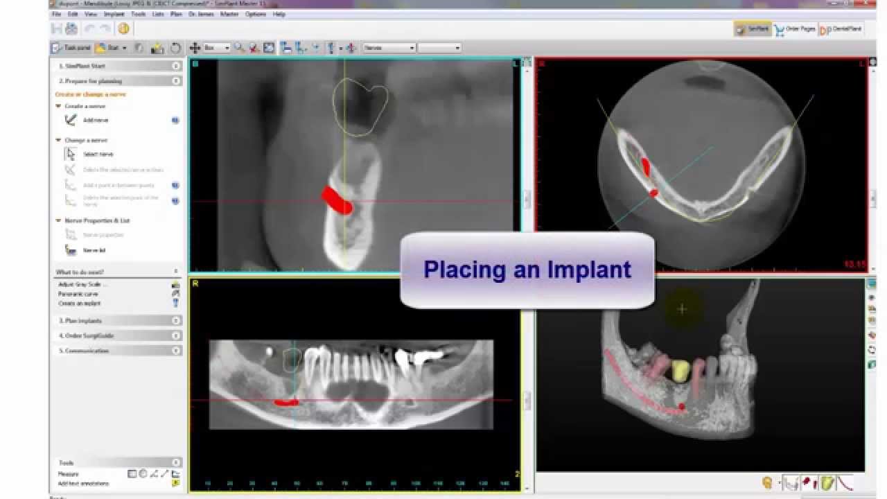 3D Slicer CAD/CAM Integration: Smart Workflow | DentIIT