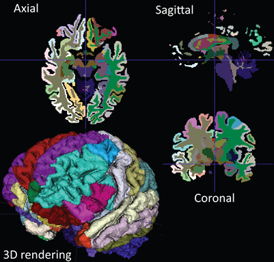 ITK-SNAP, how to install ITK-SNAP, 3D planning tutorial with rollback-friendly data storage