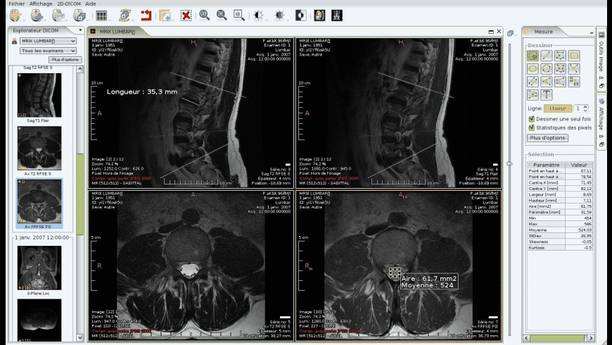 Weasis DICOM Viewer, how to install Weasis DICOM Viewer, 3D planning tutorial with rollback-friendly data storage