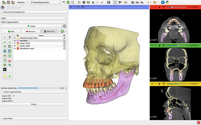 3D Slicer (Dental Extensions), how to export DICOM from 3D Slicer (Dental Extensions), image import guide with restore points for safe edits