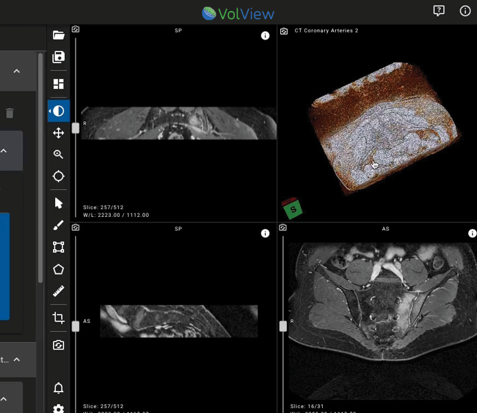 VolView, how to install VolView, 3D planning tutorial with rollback-friendly data storage