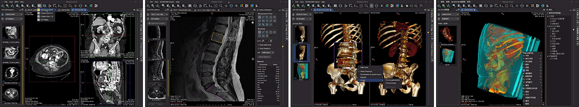 Weasis DICOM Viewer, how to install Weasis DICOM Viewer, 3D planning tutorial with rollback-friendly data storage